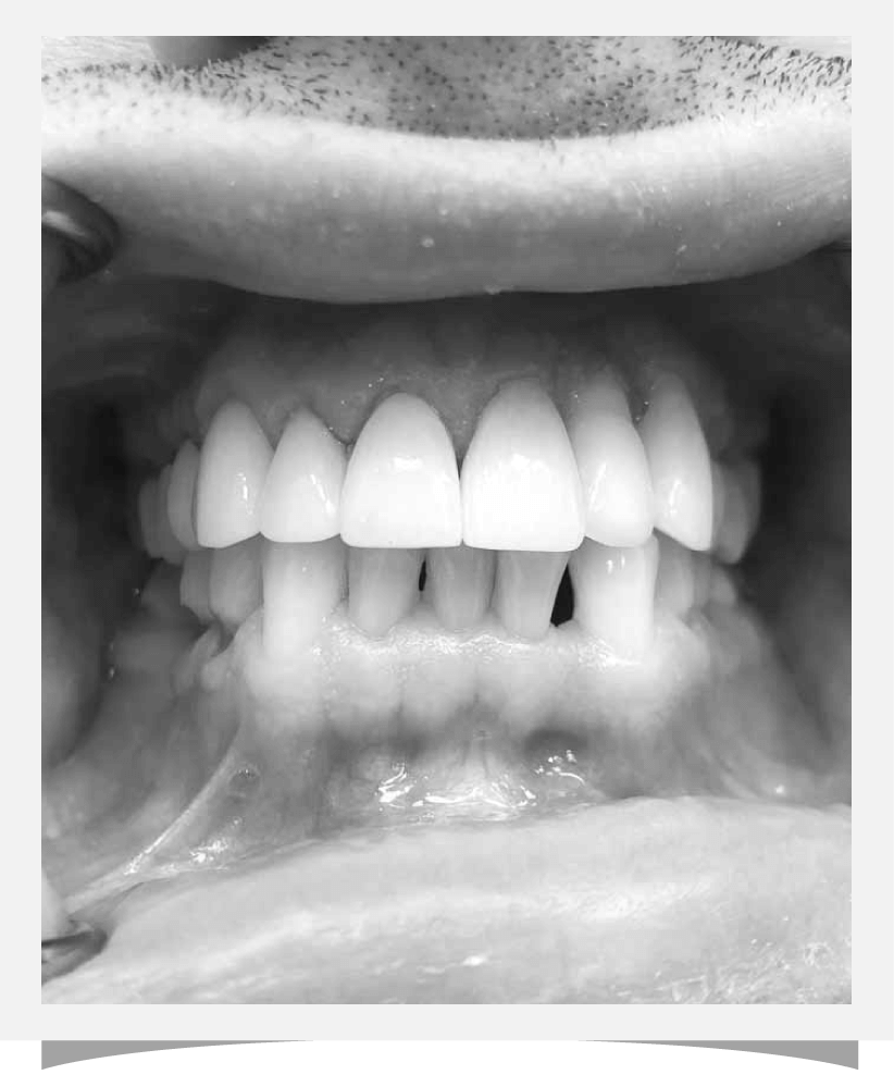 Cosmetic Dentistry Results- After 4