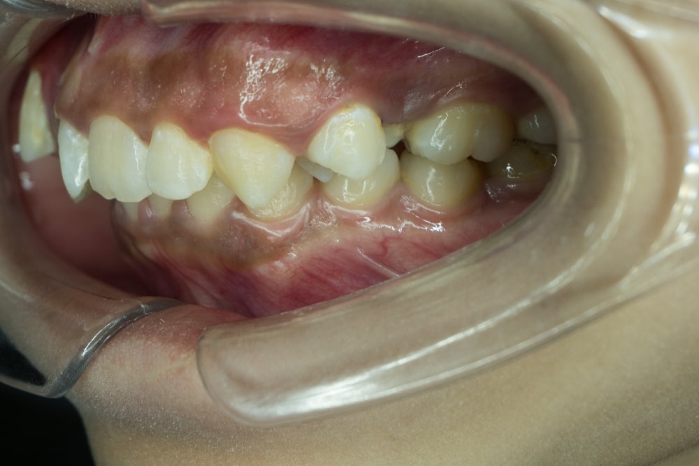 Malpositioned teeth explained