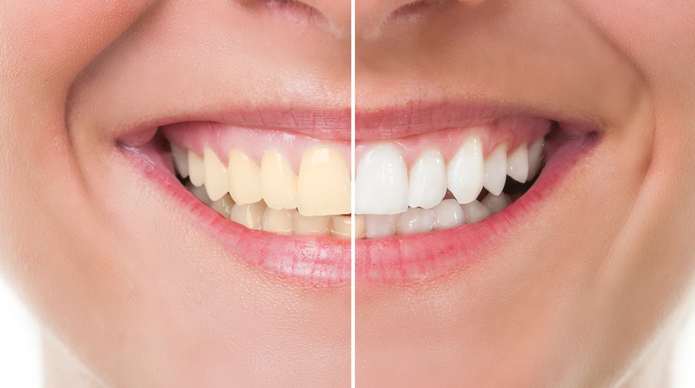 Are teeth whitening treatments worth it